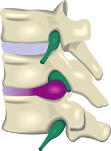 disc injury herniation, bulge, protrusion understanding and chiropractic treatment