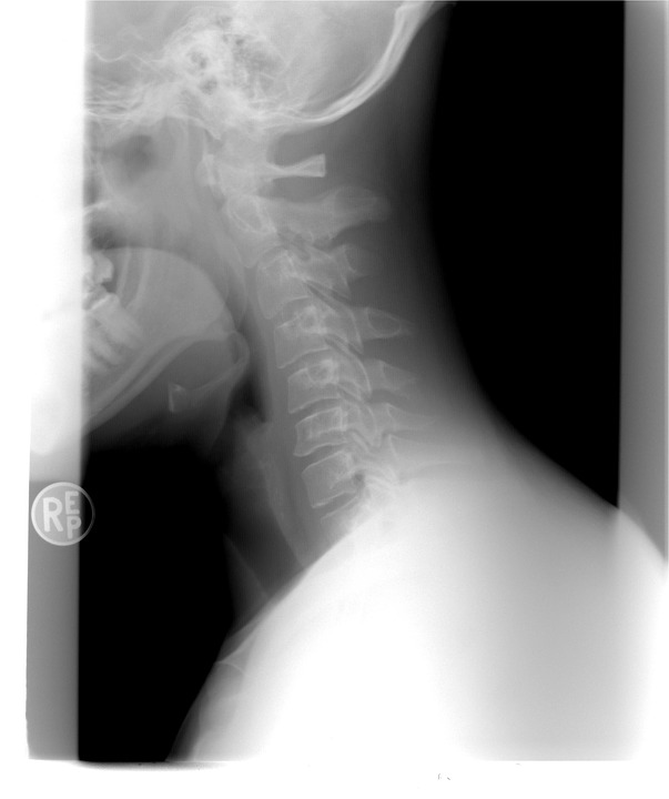 cervical posture neck pain and headaches, subluxations