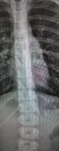 childhood scoliosis screening and treatment in texarkana
