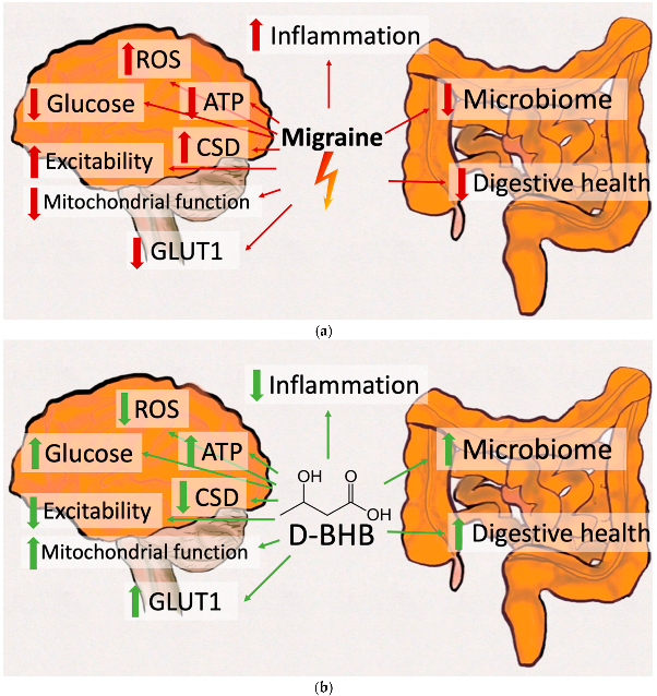 ketogenic diet for preventing migraines